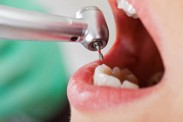 Best Dental Abscess Treatment in Tunnel Hill, GA